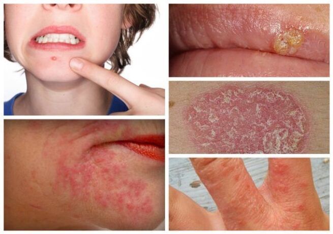 Las alergias y enfermedades de la piel son signos de parásitos en el cuerpo. 
