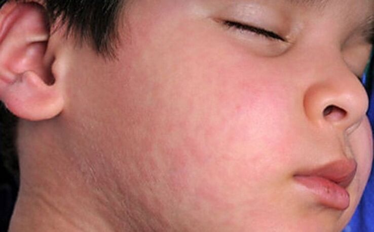 Erupciones alérgicas en la piel un síntoma de la presencia de gusanos parásitos en el cuerpo