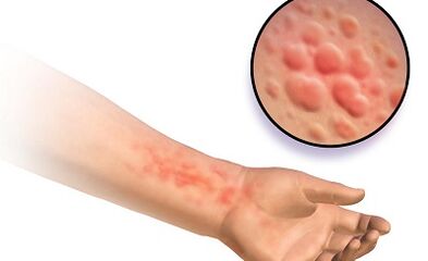 manifestaciones de esquistosomosis en humanos